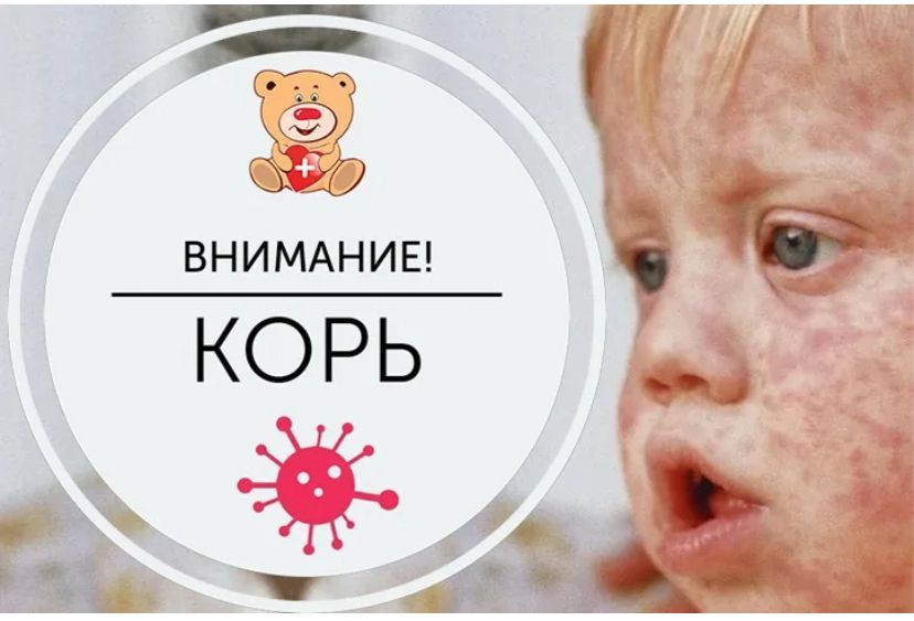 Самый эффективный способ избежать заболевания кори - привиться